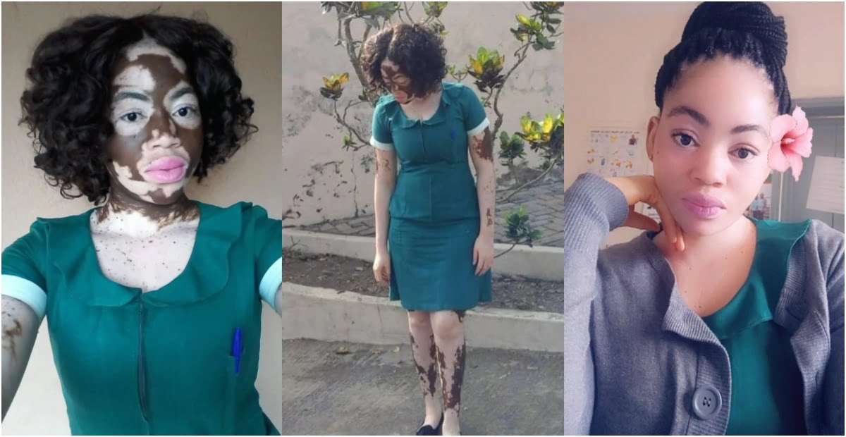 Meet Ghanaian nurse with vitiligo but stuns with her Beauty and Self-Confidence - pictures