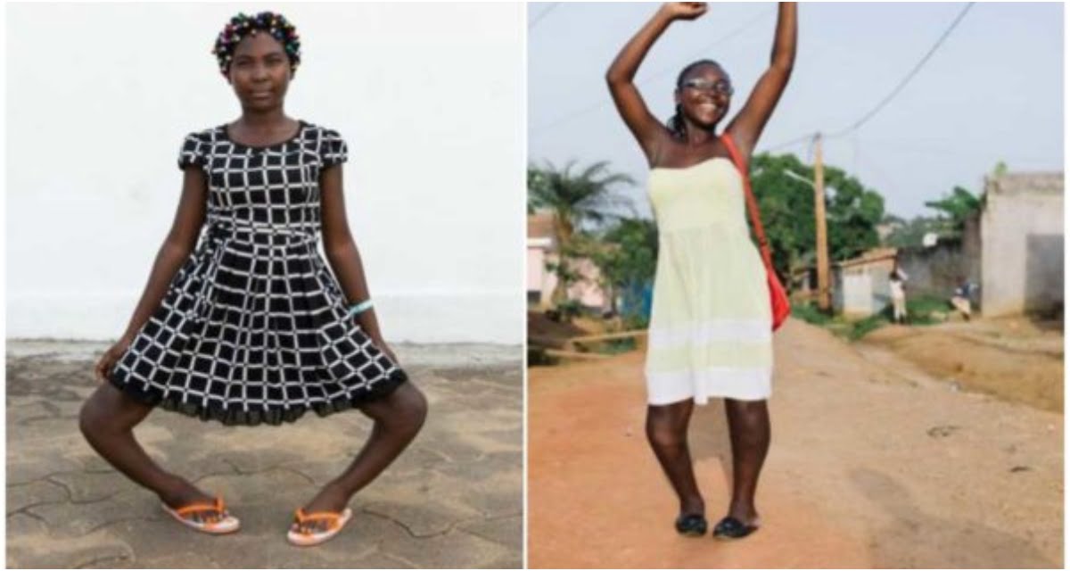 "They called me a witch" Bowlegged lady shares story after life-changing operation (photos)