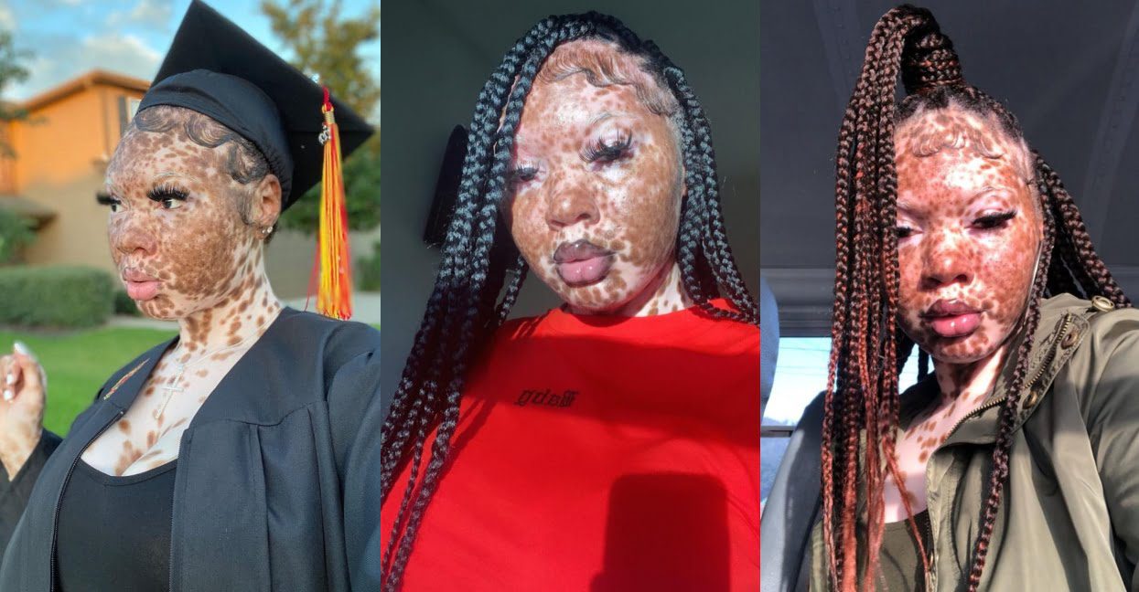 Check out photos of this beautiful model who slays despite her skin condition