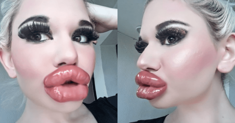 Meet Andrea, the lady who went for surgery to have the biggest mouth in the world - Photos