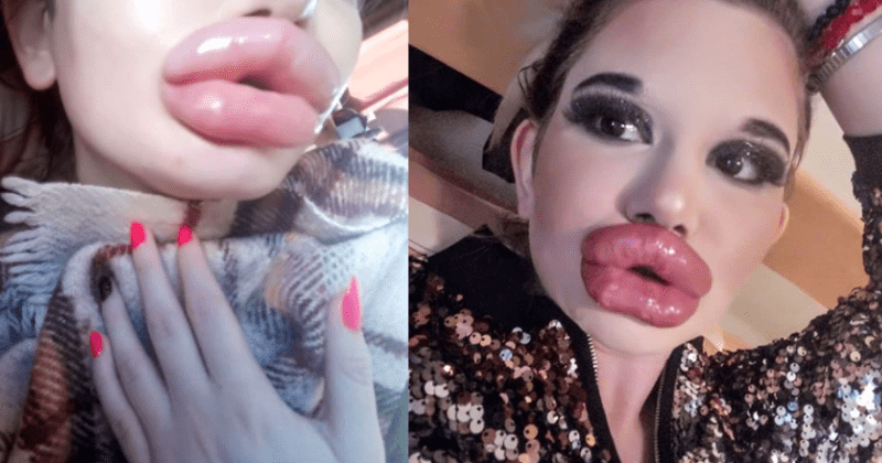 Meet Andrea, the lady who went for surgery to have the biggest mouth in the world - Photos