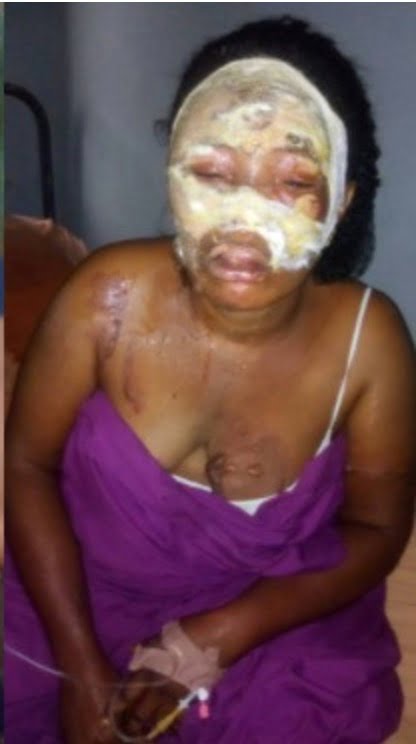 Jealous wife pours hot water on her fellow woman for sleeping with husband
