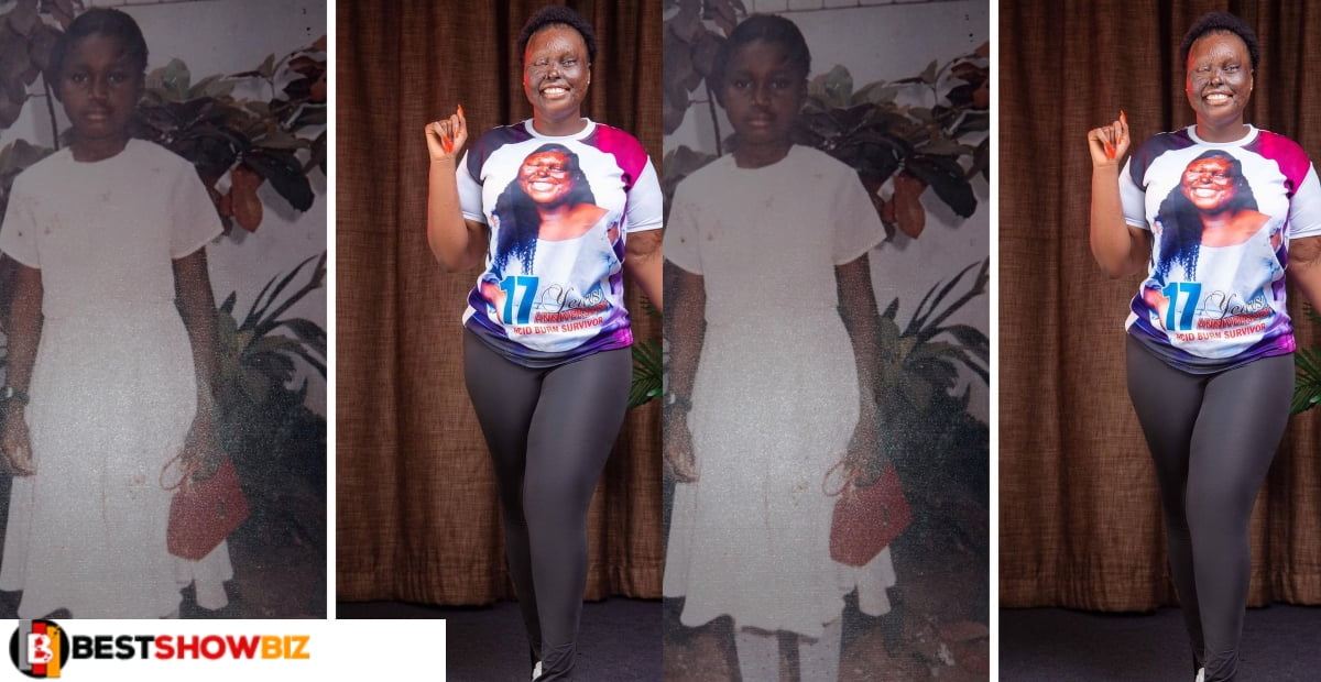 Acid survivor shares beautiful photos of herself before her uncle’s wife attacked her with Acid