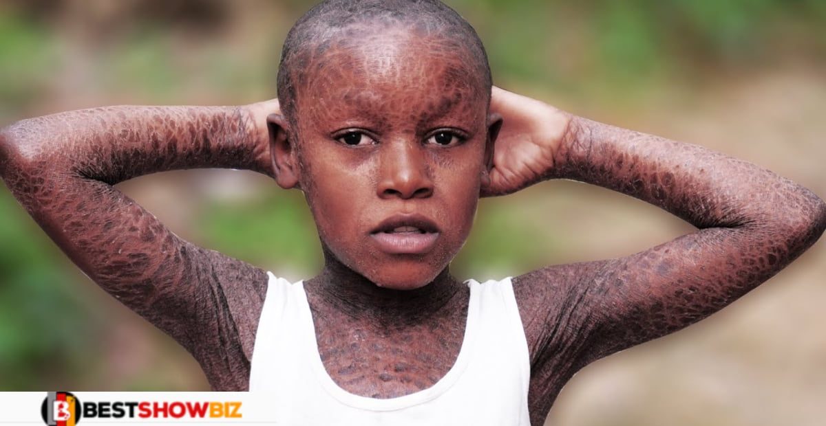 Video: Meet the 11-year-old boy whose skin looks like a snake