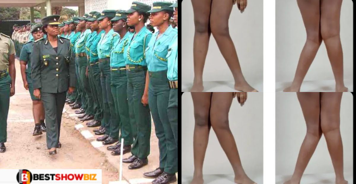 I was disqualified at the Immigration Service Screening because of my 'K' legs - Lady cries out