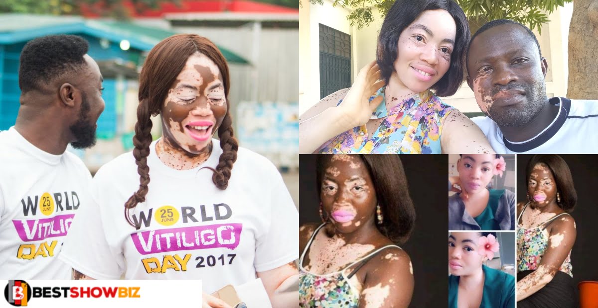 Meet Enam, the beautiful nurse with vitiligo skin condition changing lives with her foundation