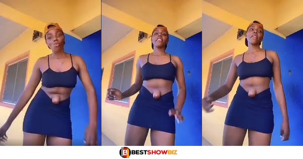 Lady with huge Belly Button goes viral after she showcased her deformity with confidence (video)