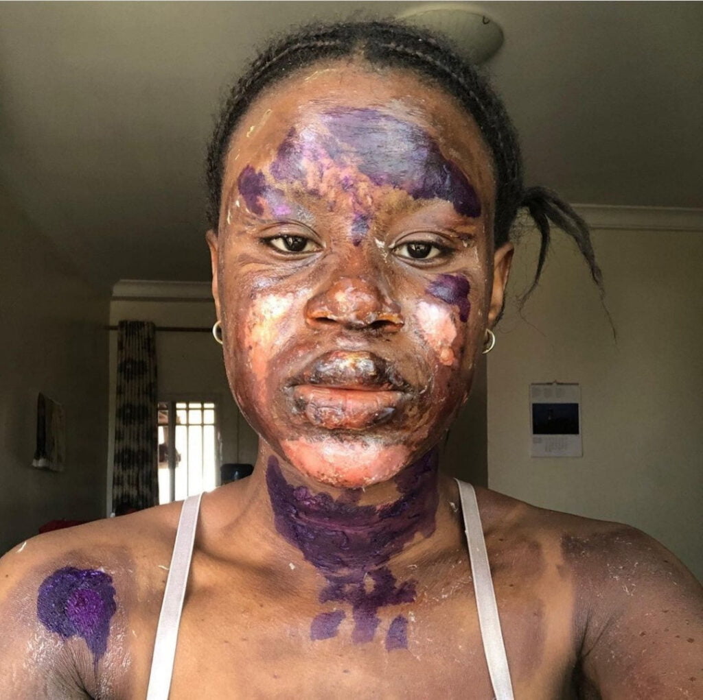 Lady Who Survived Burns Shares Her Amazing Transformation Without Scars