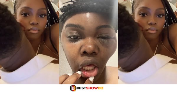 See how a man disfigured the face of his beautiful girlfriend with beatings (photos)