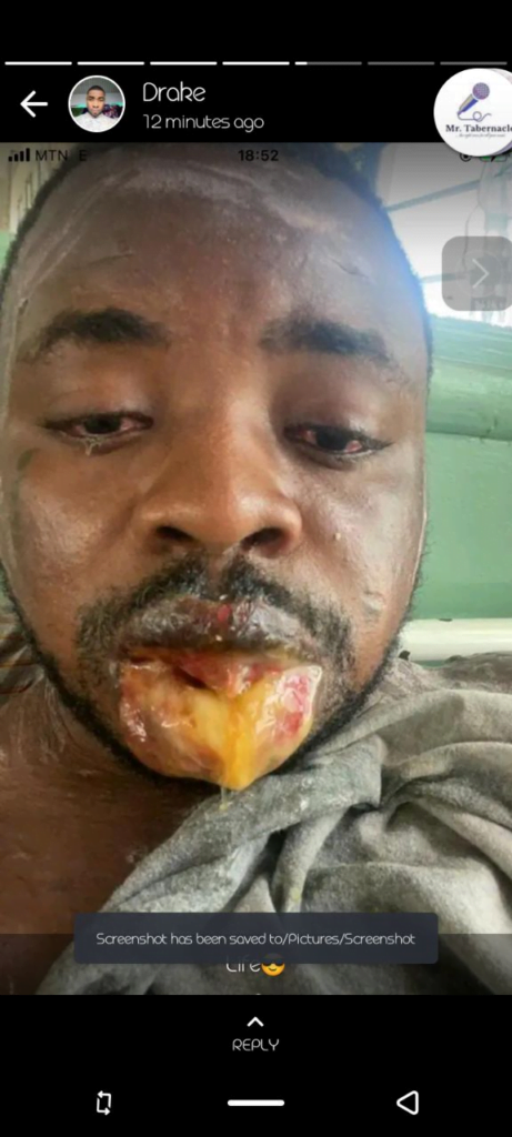 Sakawa boy gets rotten lips after the ritual he did expired
