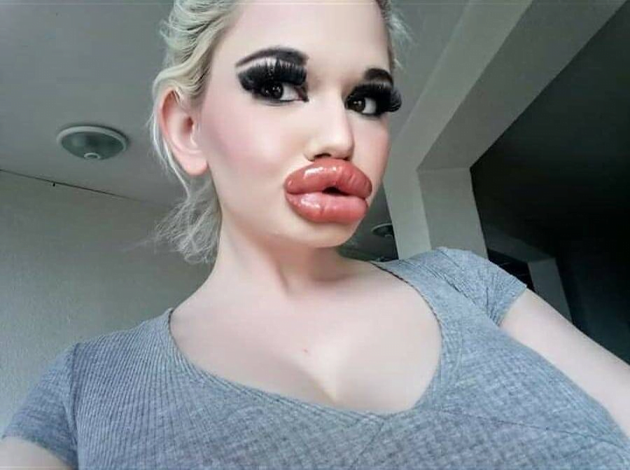 woman with the biggest lips in the world - Andrea Ivanova