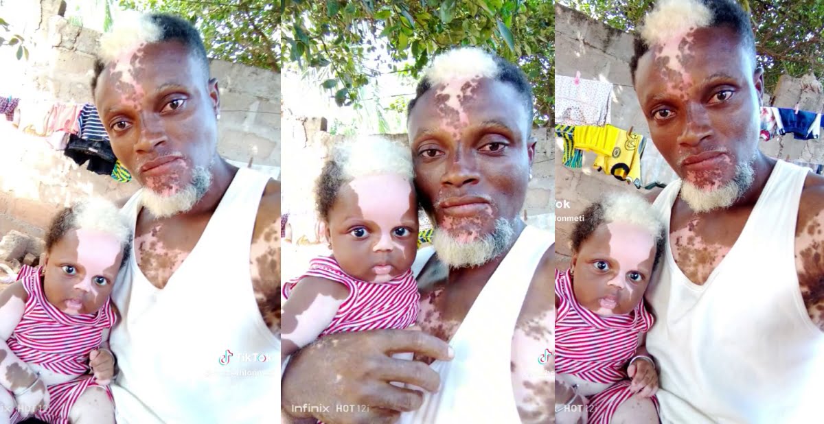 Video Of a Man And His Baby With The Same White Marks on Their Face And Body Go Viral
