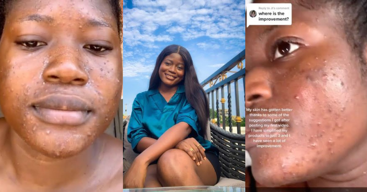 Lady's Face Full Of Acne After Shaving Her Face After Watching A Beauty Hack