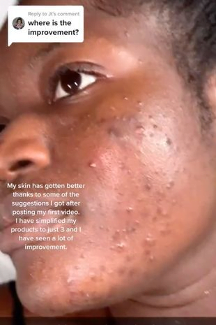Lady's Face Full Of Acne After Shaving Her Face After Watching A Beauty Hack