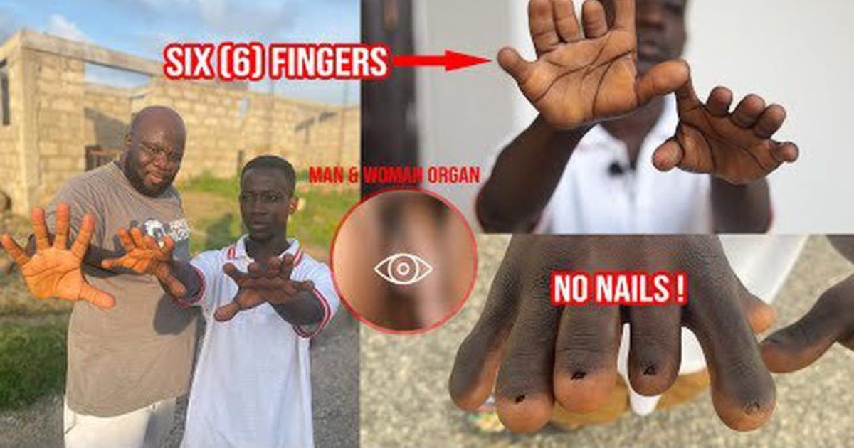 Young Ghanaian Boy With 6 Fingers, Vαg!nα and Pɛn!s Cries For Help In New Video