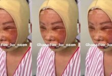Botched Facelift get a Ghanaian lady looking like a beaten boxer – Video.