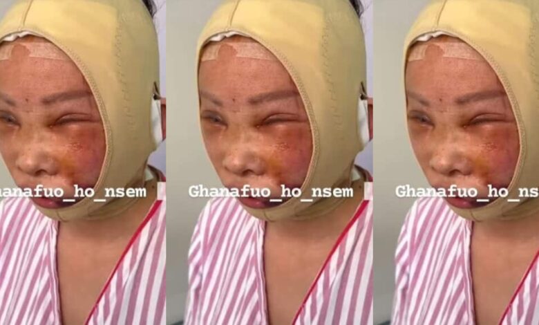 Botched Facelift get a Ghanaian lady looking like a beaten boxer – Video.